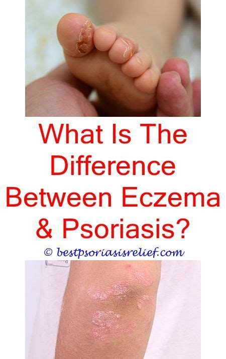 Pin On Eczema Local Treatment