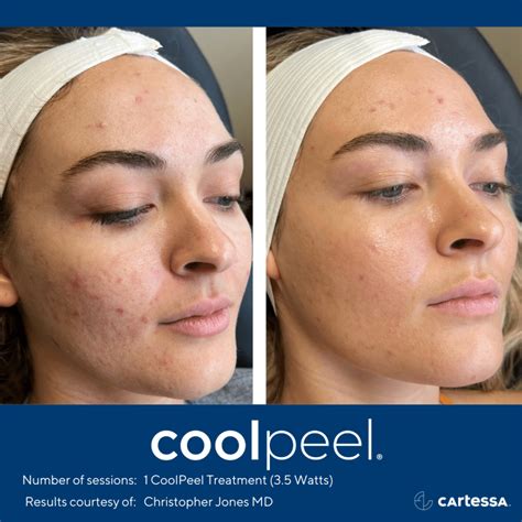 Tetra Coolpeel Co2 In Washington Dc Skin Rejuvenation Laser