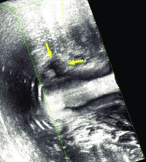 Three Dimensional Endoanal Ultrasound Image Of The Perianal Abscess Download Scientific Diagram