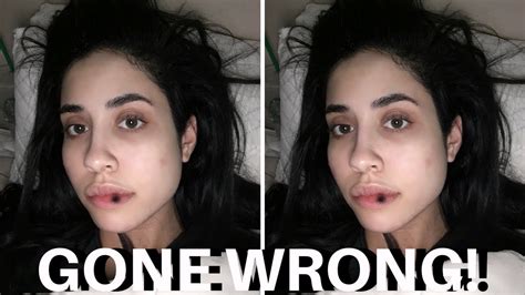When lip fillers go wrong. LIP INJECTIONS GONE WRONG! - YouTube