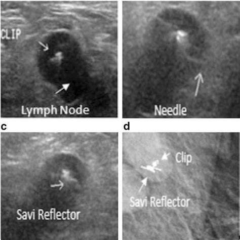 Specimen Radiography Confirming Reflector And Biopsy Clip Within Lymph