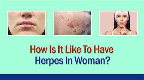 How Is It Like To Have Herpes In Woman Genital Herpes Oral Herpes Natural Herpes Treatment