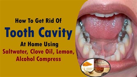 So many names for different types of teeth jewelry, a retro trend that everyone is hopping on at the moment. how to get rid of tooth cavity at home using saltwater ...