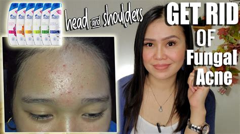 How To Get Rid Of Fungal Acne With Head And Shoulders Updated Youtube