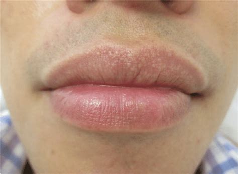 sebaceous glands lips pictures