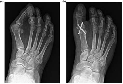 Incidence Of Nonunion Following First Metatarsophalangeal Joint