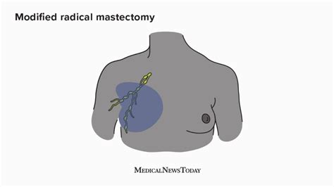 Radical Mastectomy Definition Procedure And Recovery