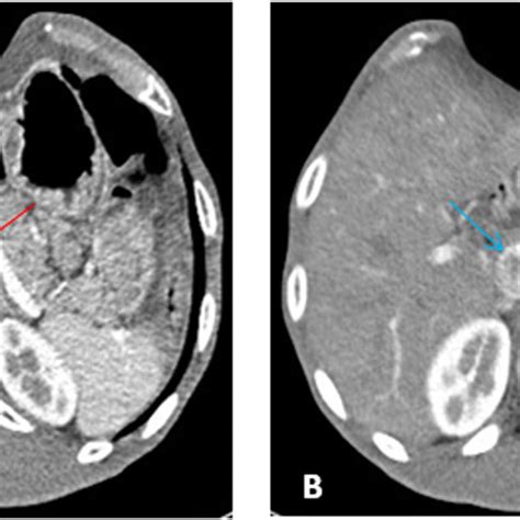 Contrast Enhanced Axial Ct Scans Of Acs Showing Distended Abdomen