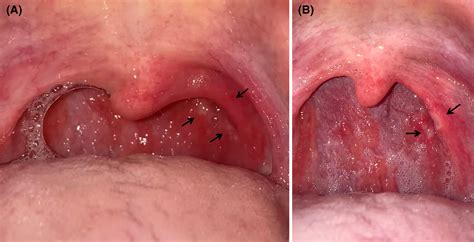 Tiny White Spots On Throat Not Strep