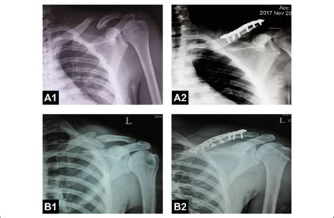 A1 And A2 Shows Pre Op And Post Op X Rays Of Fixation With Precontoured