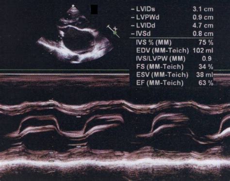 M Mode Echocardiogram In Mitral Stenosis All About Cardiovascular System And Disorders