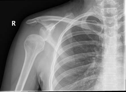 Inferior Shoulder Dislocation Radiology Reference Article Radiopaedia Org