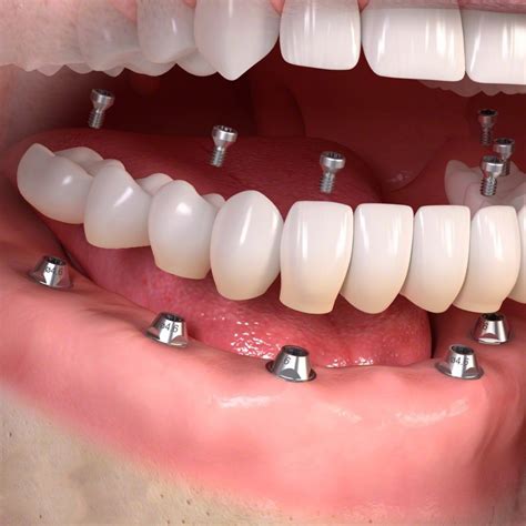 Dental Implants Somerset Resolution Specialist Treatment Centre