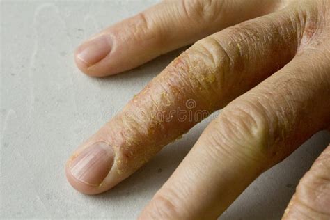 Cierre De La Dermatitis Eczema En Manos Y Dedos Del Hombre Descamación