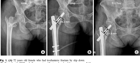 Figure 1 From A Comparative Study Of Trochanteric Fractures Treated
