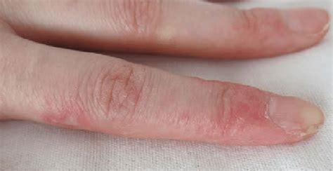 Fingers With Erythema Patient With Systemic Lupus Erythematosus