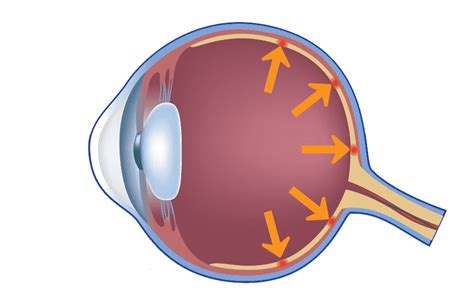 Once the overall shape of the cornea is altered, the prescription/power of the eye can be changed. Complete Eye Examination | Cataract Malaysia | Optimax Eye ...