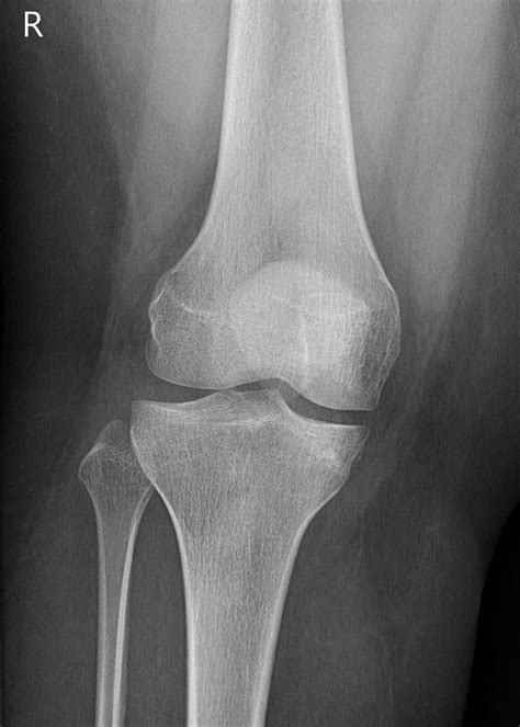 Knee Upside Down Bmj Case Reports