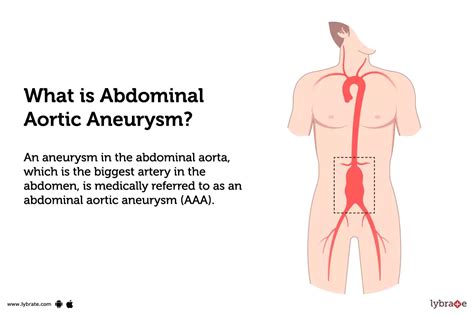 Abdominal Aortic Aneurysm Causes Symptoms Treatment And Cost