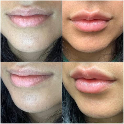Before And Immediately After 1ml Lip Filler First Time Rplasticsurgery