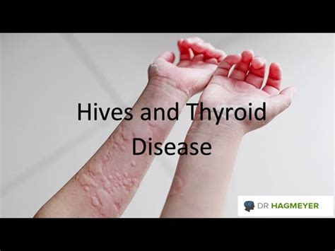 Consider These 5 Areas When It Comes To Treating Chronic Hives Dr