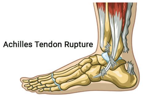 Achilles Tendon Rupture Orthopedic Center For Sports Medicine Sports