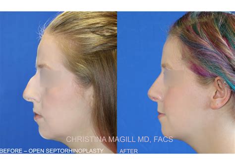 Rhinoplasty And Nasal Vestibular Stenosis Repair Before And After