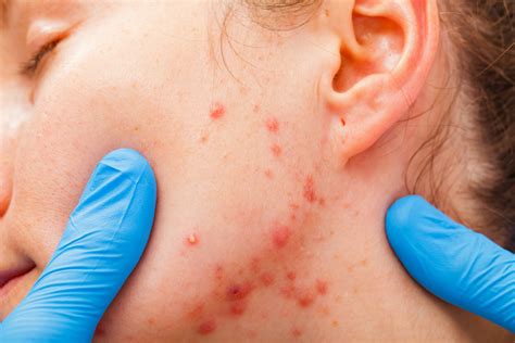 What Is Cystic Acne Causes Treatments And Prevention