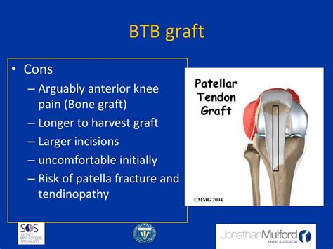 Ppt Sports Knee Surgery Acl Graft Choice Powerpoint Presentation Id