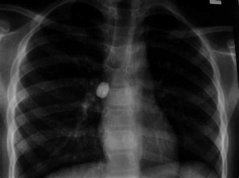 X‑ray Of The Chest Shows Foreign Body In Right Bronchus Download