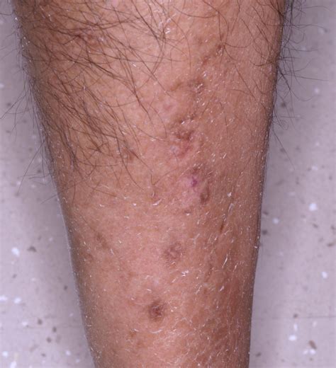 Diabetic Dermopathy Pigmented Pretibial Patches Of Diabetes Mellitus