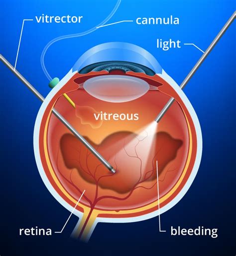 Vitrectomy And Vitreoretinal Procedures All About Vision