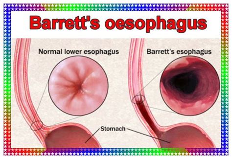 Barretts Oesophagus Barretts Esophagus Barrett Reflux Disease