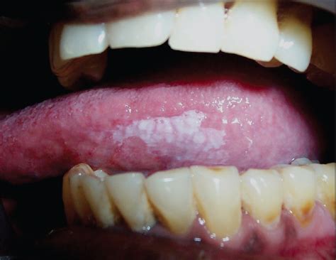 Oral Leukoplakia Management Protocol For Primary Health Care Providers