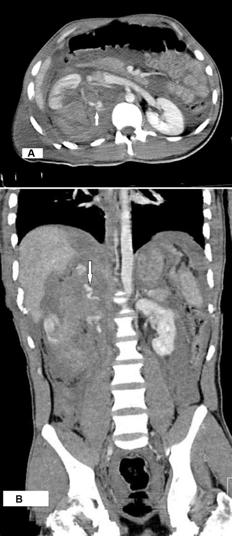 Contrast Enhanced Ct Scan For A Patient With Blunt Renal Trauma During