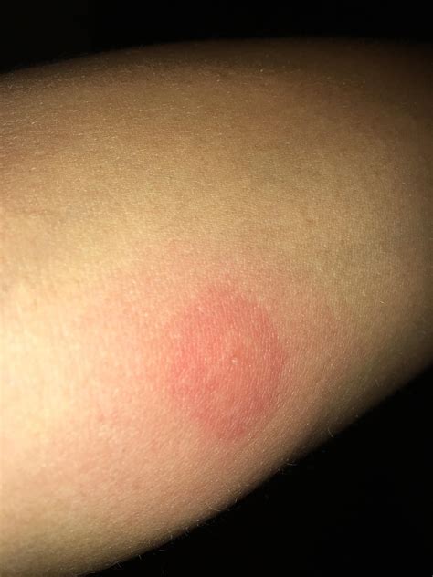 Can Anyone Tell Me If This Is A Spider Bite Is So What Should I Do For
