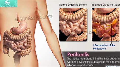 Que Es La Peritonitis Causas Y S Ntomas Youtube