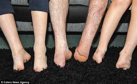 Kian And Callum Jarram Born With No Toes Get Their First Prosthetic