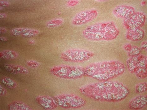 Psoriasis Diagnostic Et Ordonnance Consultez Sur Livi