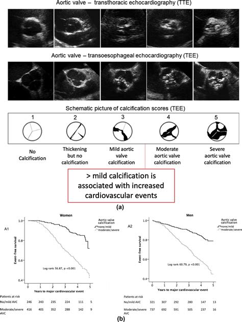 Imaging Aortic Valve Calcification Significance Approach And