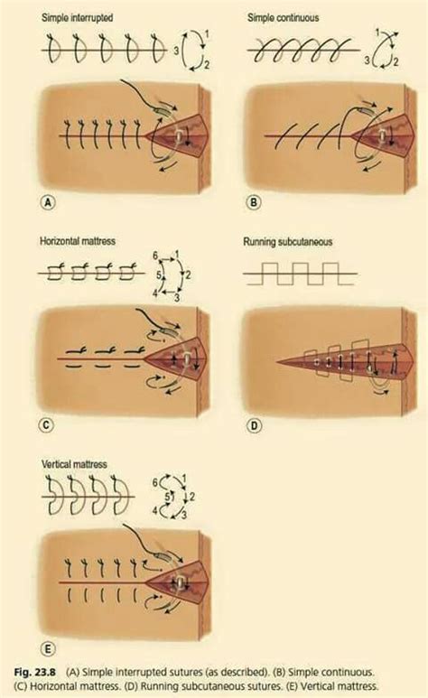 Suture Medical School Studying Surgical Nursing Surgical Suture