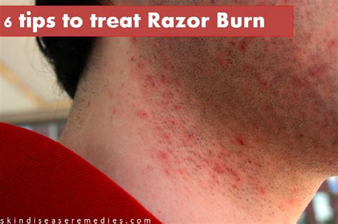 How To Get Rid Of Razor Burn Instantly Skin Disease Remedies