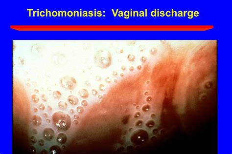Vaginal Discharge Syndromes Vaginal Infections And Cervicitis