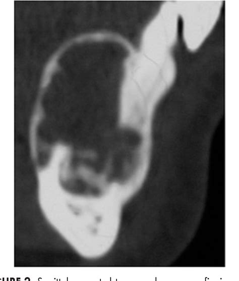 Figure 2 From Management Of Central Giant Cell Granuloma Of Mandible