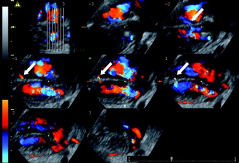 Role Of Tomographic Ultrasound Imaging With Spatiotemporal Image