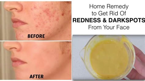 How to remove blemishes from face. Home Remedy to get rid of REDNESS or RED SPOTS from your ...