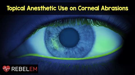 Topical Anesthetic Use On Corneal Abrasions REBEL EM Emergency