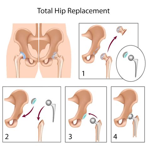 hip surgery total hip replacement templeton dr william sima md