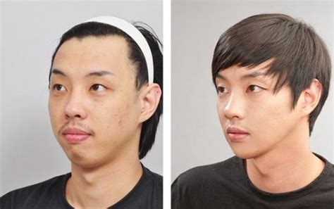 Young Koreans Before And After Extreme Plastic Surgery 50 Pictures