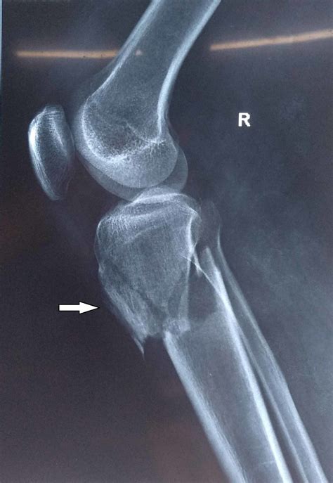 Tibial Fracture X Ray